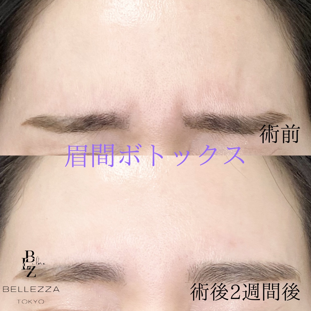 アラガン製ボトックスの施術前と施術後の症例写真