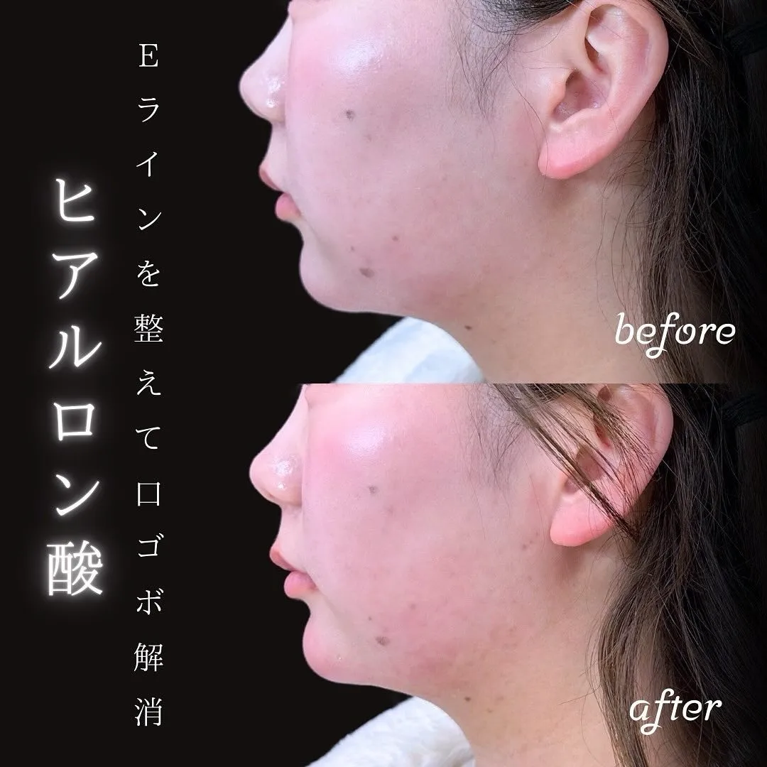 あごヒアルロン酸注入の症例写真（施術前・施術後・横顔）
