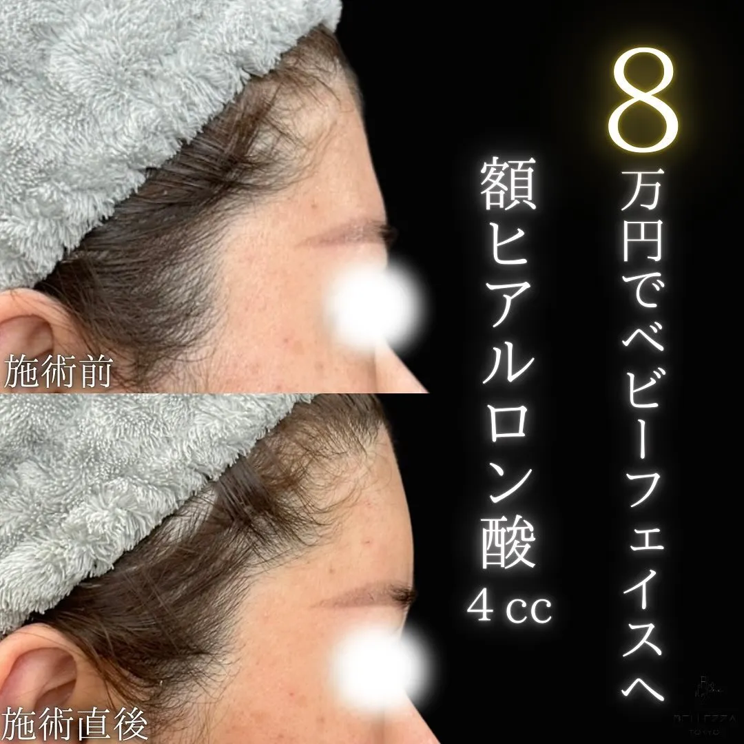額ヒアルロン酸注入の症例写真（施術前・施術後・横顔）