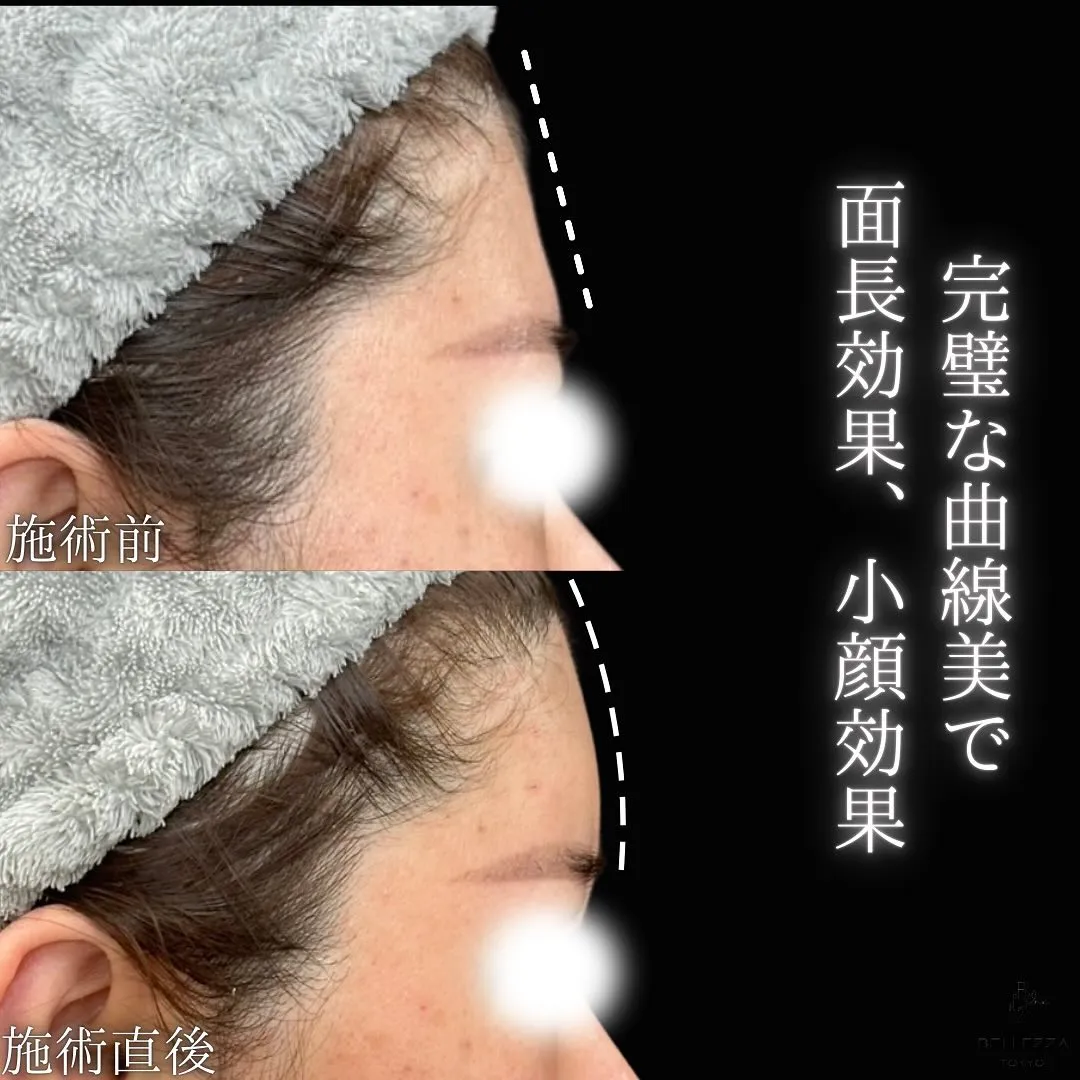 額ヒアルロン酸注入の症例写真（施術前・施術後・横顔）