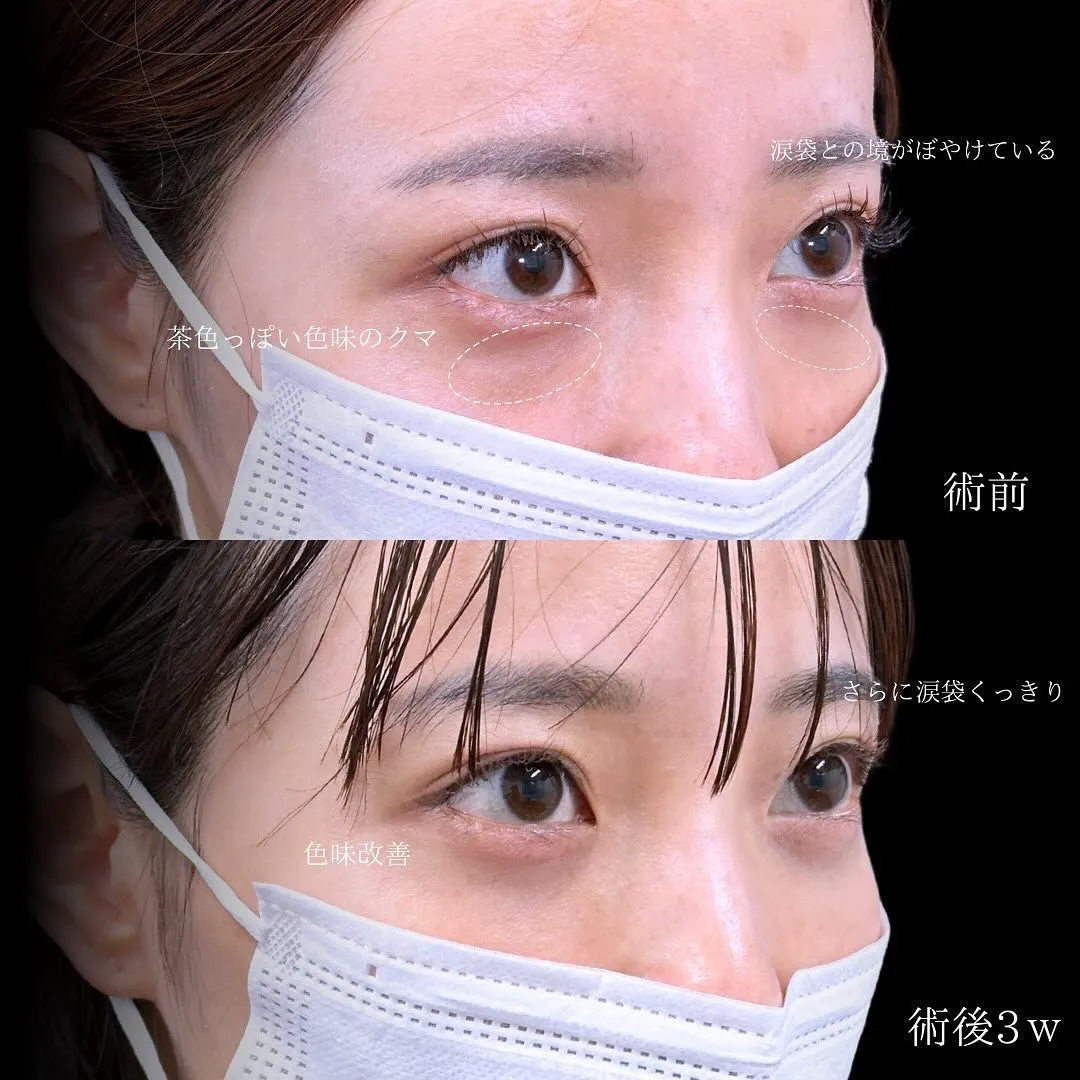 切らないクマ取りのアップ症例写真（施術前・施術後3週間）