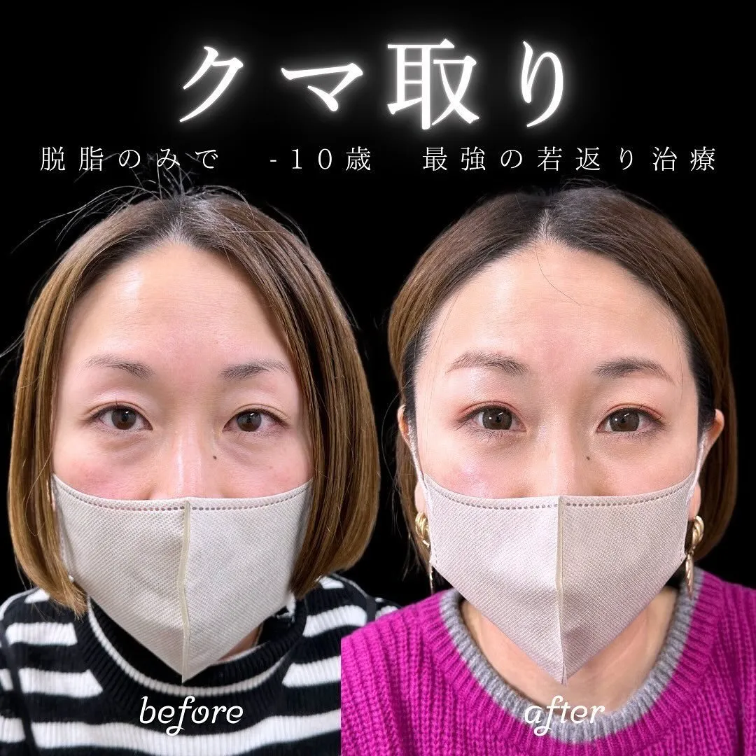切らないクマ取りの症例写真（施術前・施術後1週間）