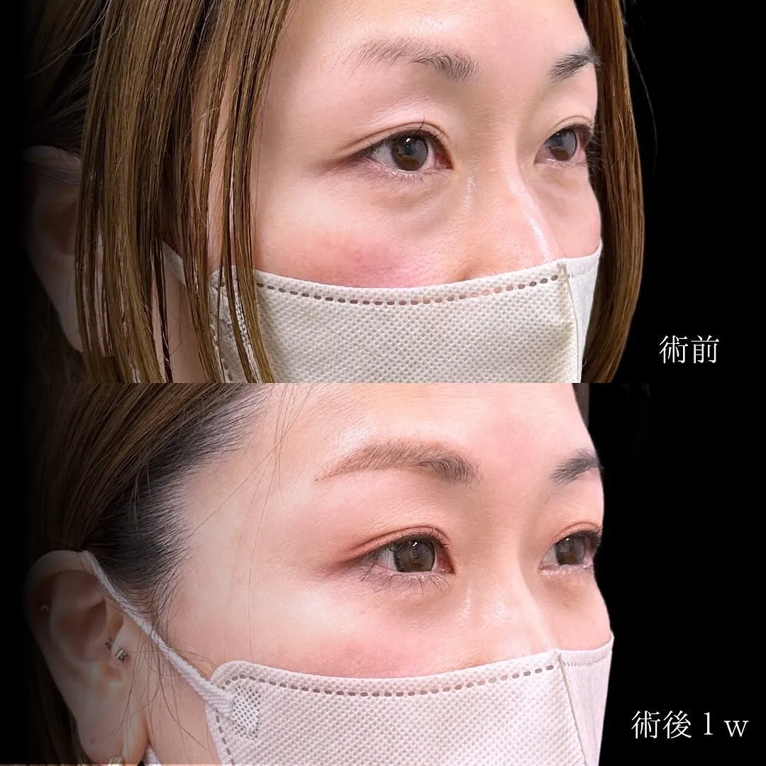 切らないクマ取りのアップ症例写真（施術前・施術後1週間）