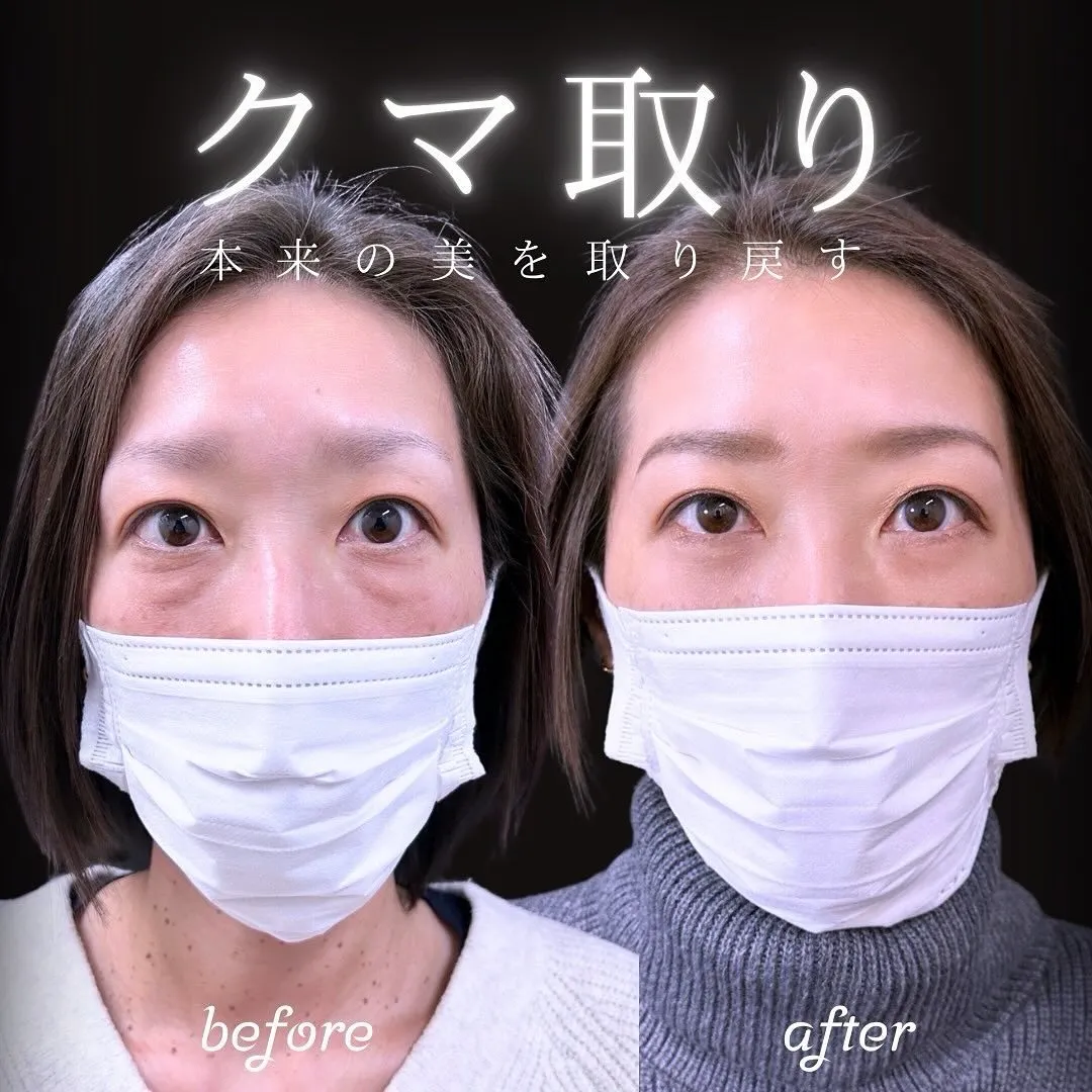 切らないクマ取りの症例写真（施術前・施術後1週間）