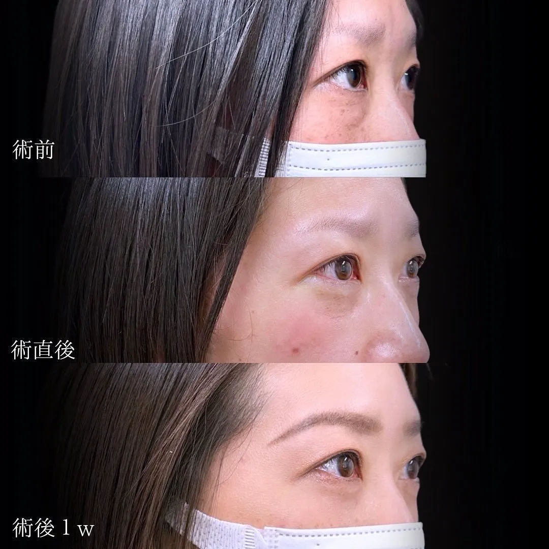 切らないクマ取りの症例写真（施術前・施術直後・施術後1週間）