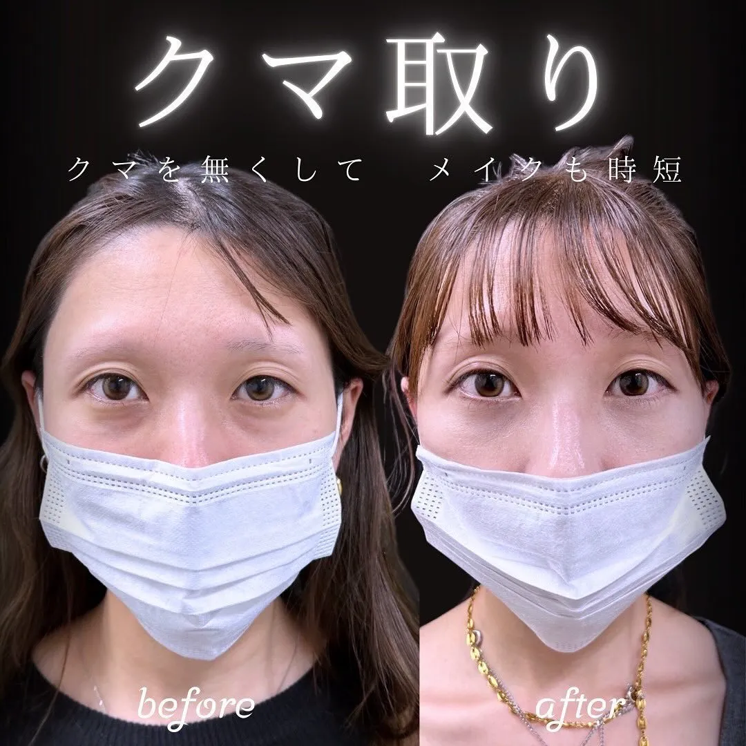 切らないクマ取りの症例写真（施術前・施術後3週間）