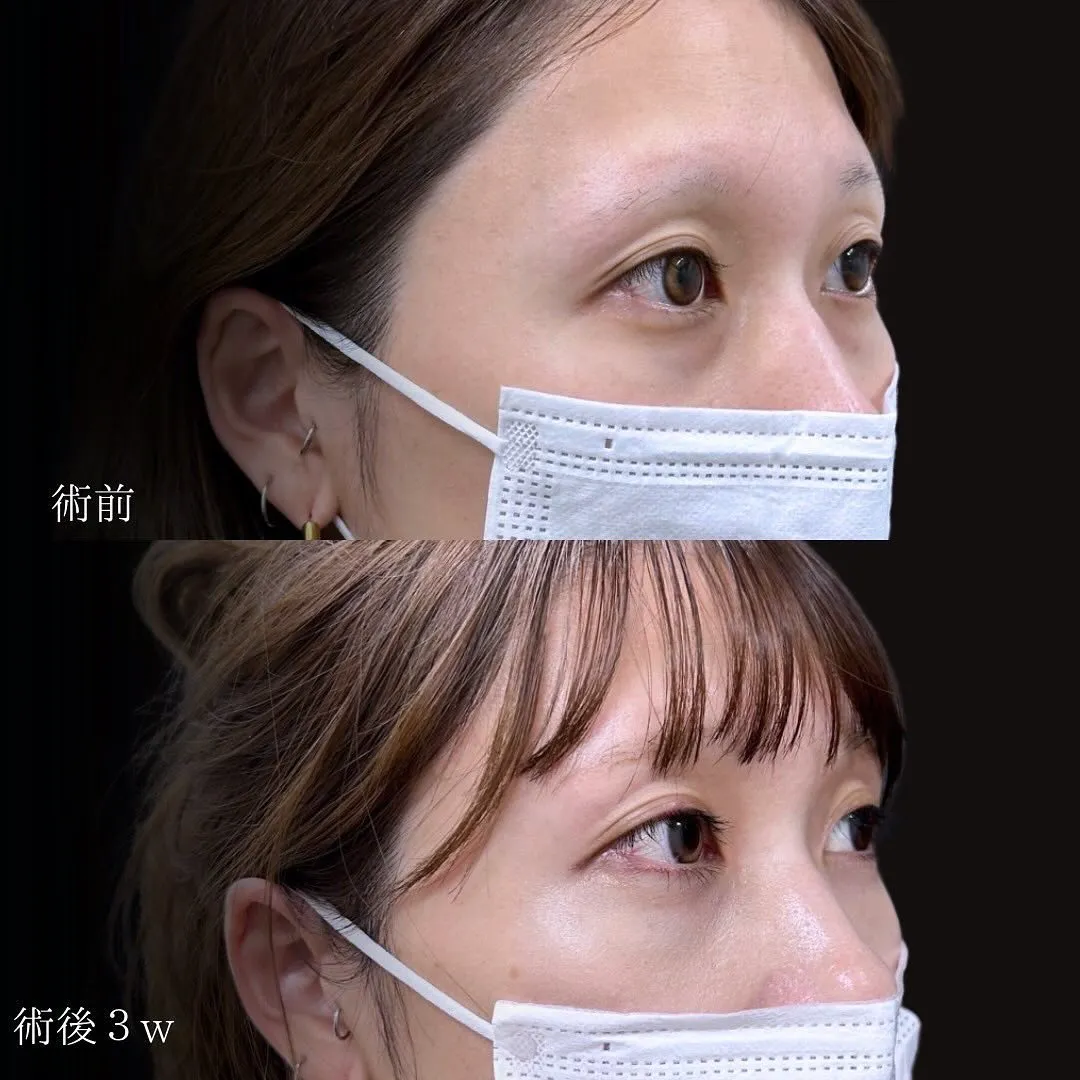切らないクマ取りのアップ症例写真（施術前・施術後3週間）