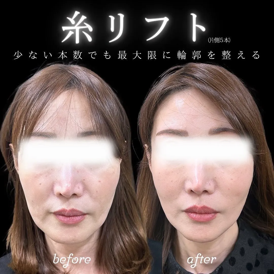 糸リフト（10本）の症例写真（施術前・施術後）