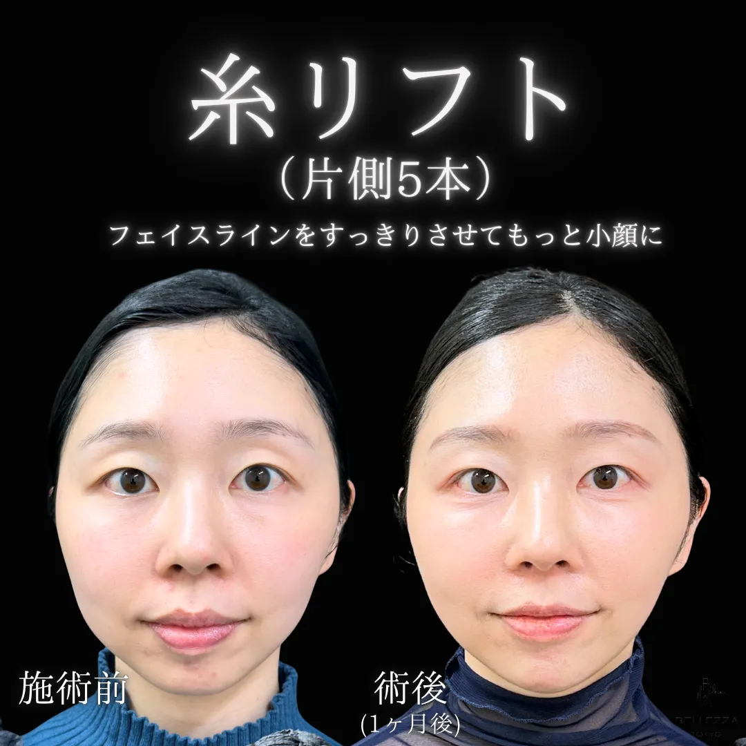 糸リフト（10本）の症例写真（施術前・施術後）