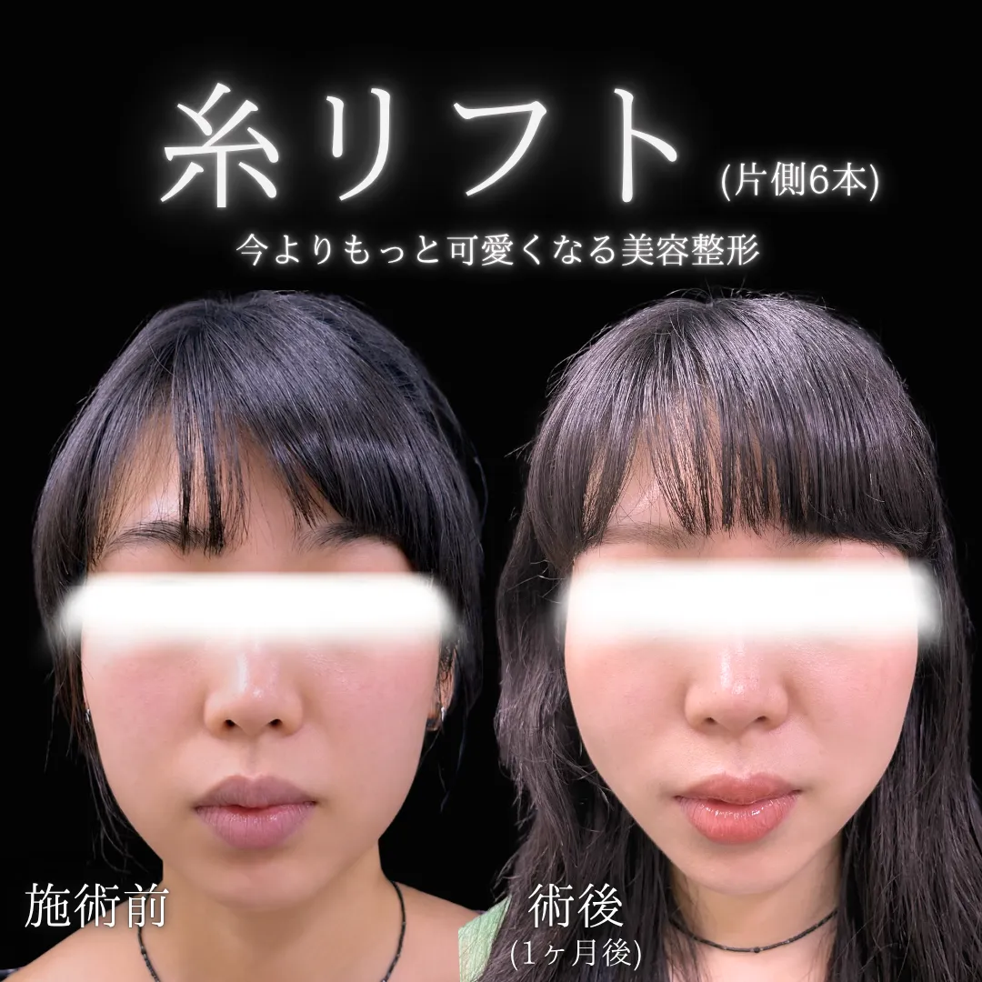 糸リフト（10本）の症例写真（施術前・施術後）