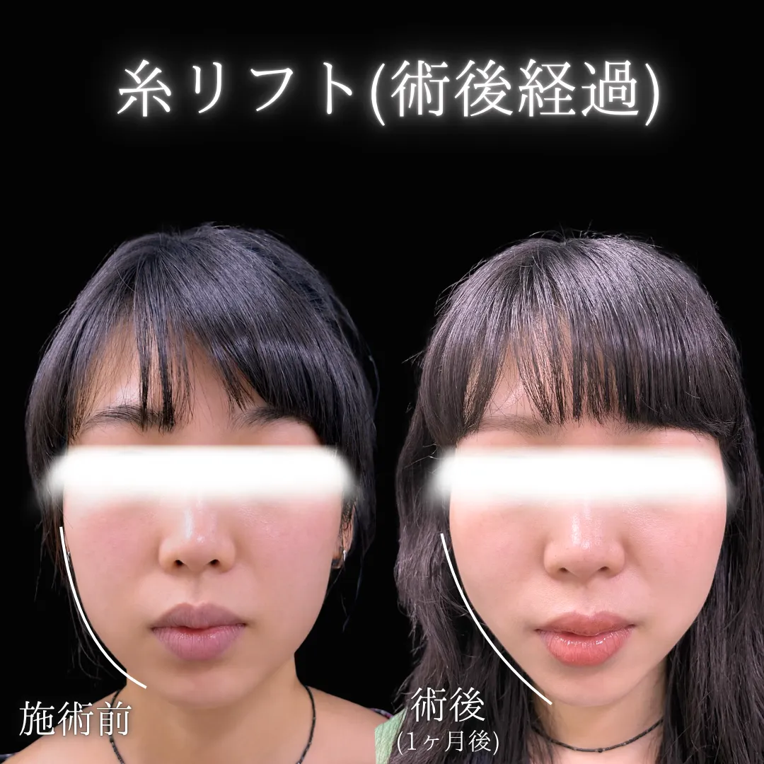 糸リフト（10本）の症例写真（施術前・施術後）