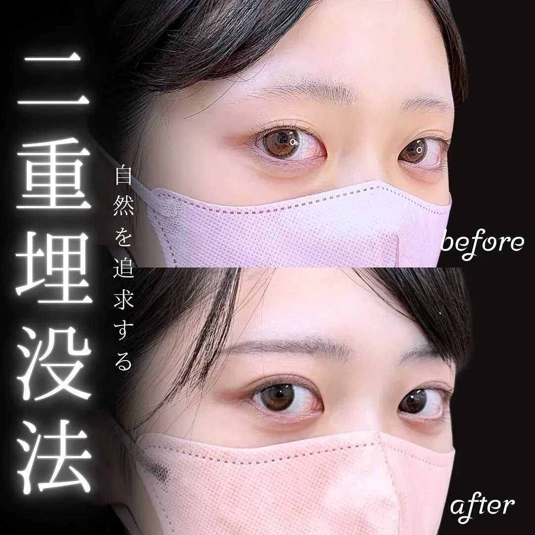 二重埋没の症例写真（施術前・施術後・斜め）