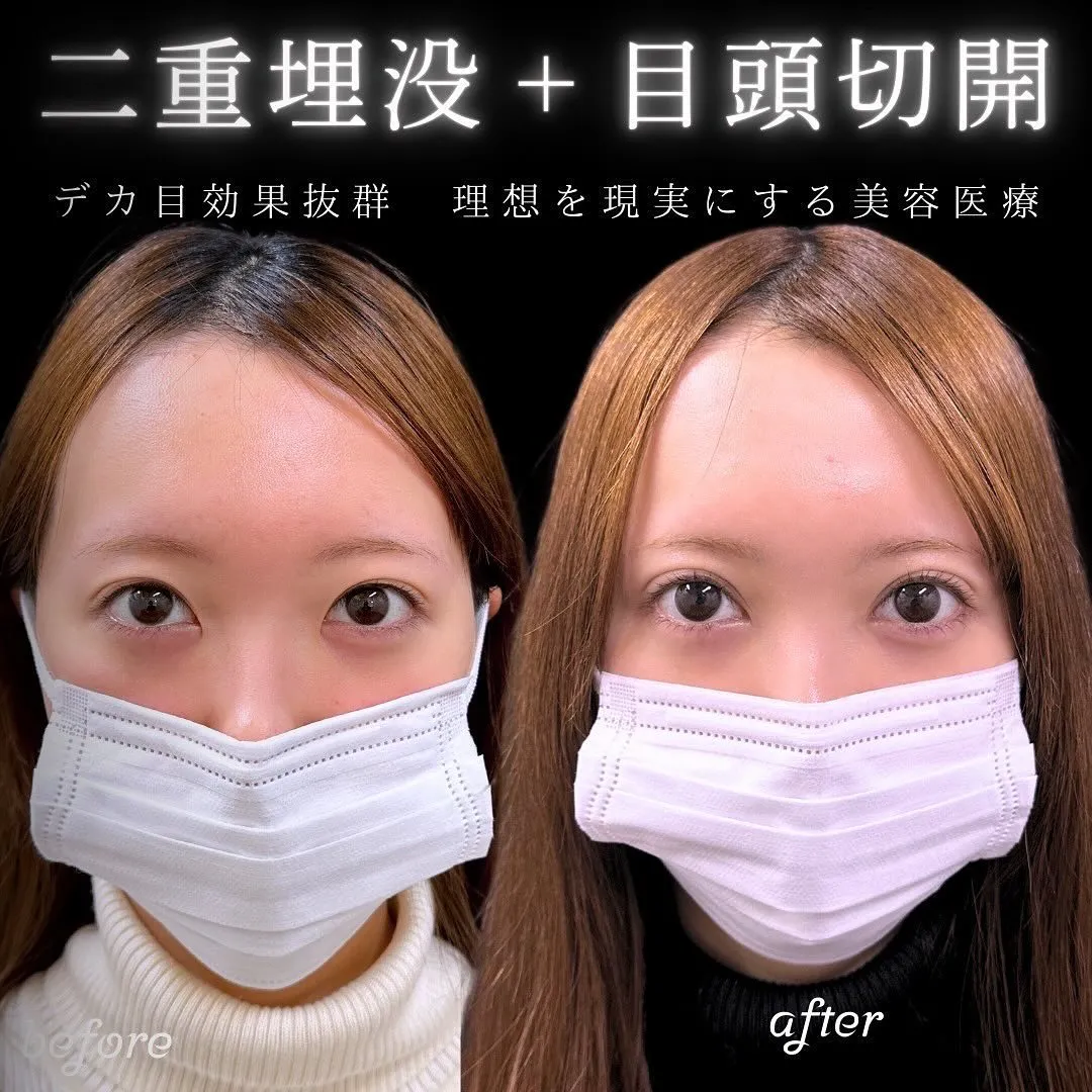目頭切開の症例写真（施術前・施術後）