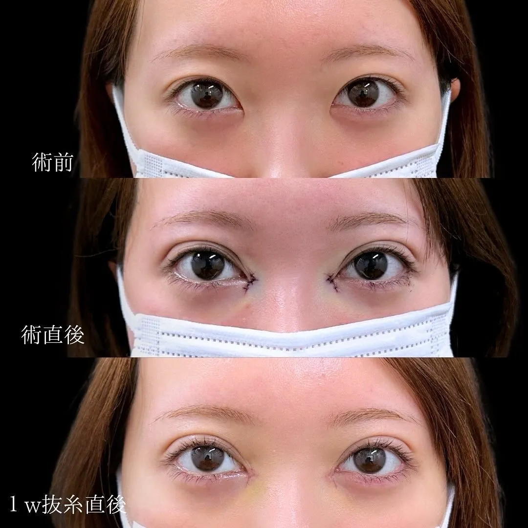 二重埋没の症例写真（施術前・施術直後・1週間抜糸後）
