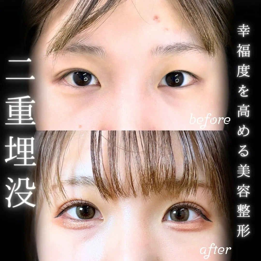 末広型二重埋没の症例写真（施術前・施術後）