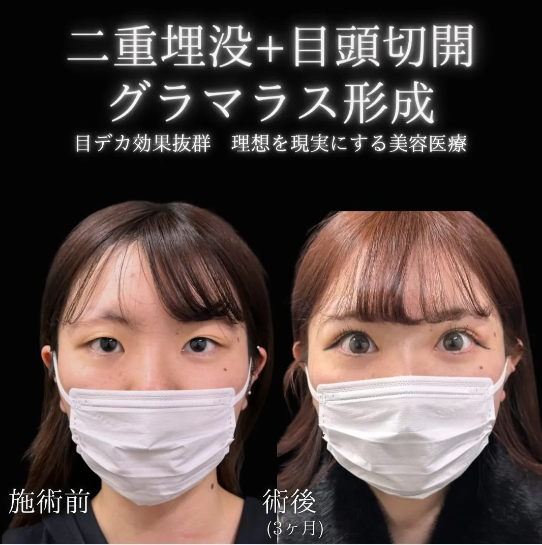 二重埋没・目頭切開・グラマラスライン形成の症例写真（施術前・3か月後）