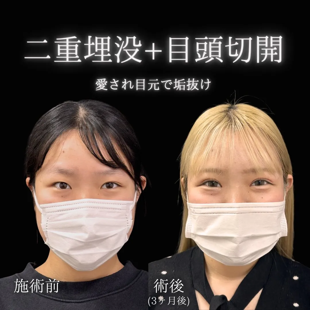 目頭切開の症例写真（施術前・施術後1か月）