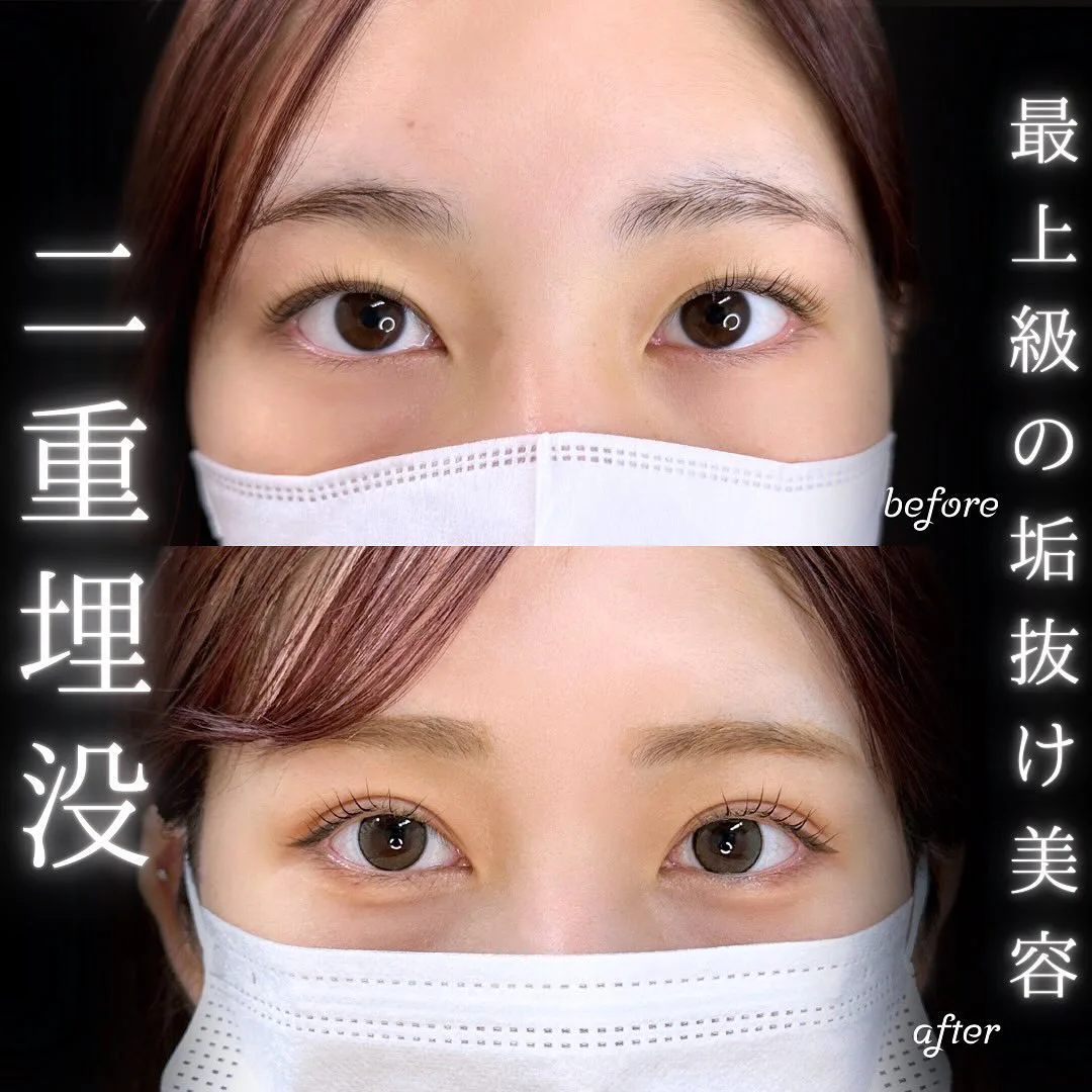 自然な二重埋没の症例写真（施術前・施術後・正面）