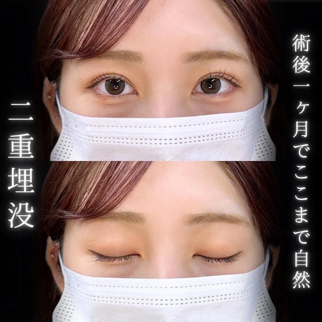 自然な二重埋没の症例写真（施術前・施術後・閉眼時）