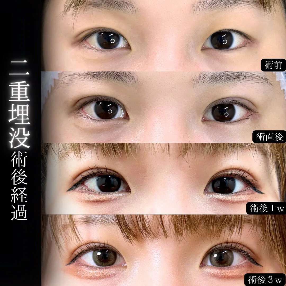 自然な二重埋没の症例写真（施術前・施術直後・1週間後・3週間後）