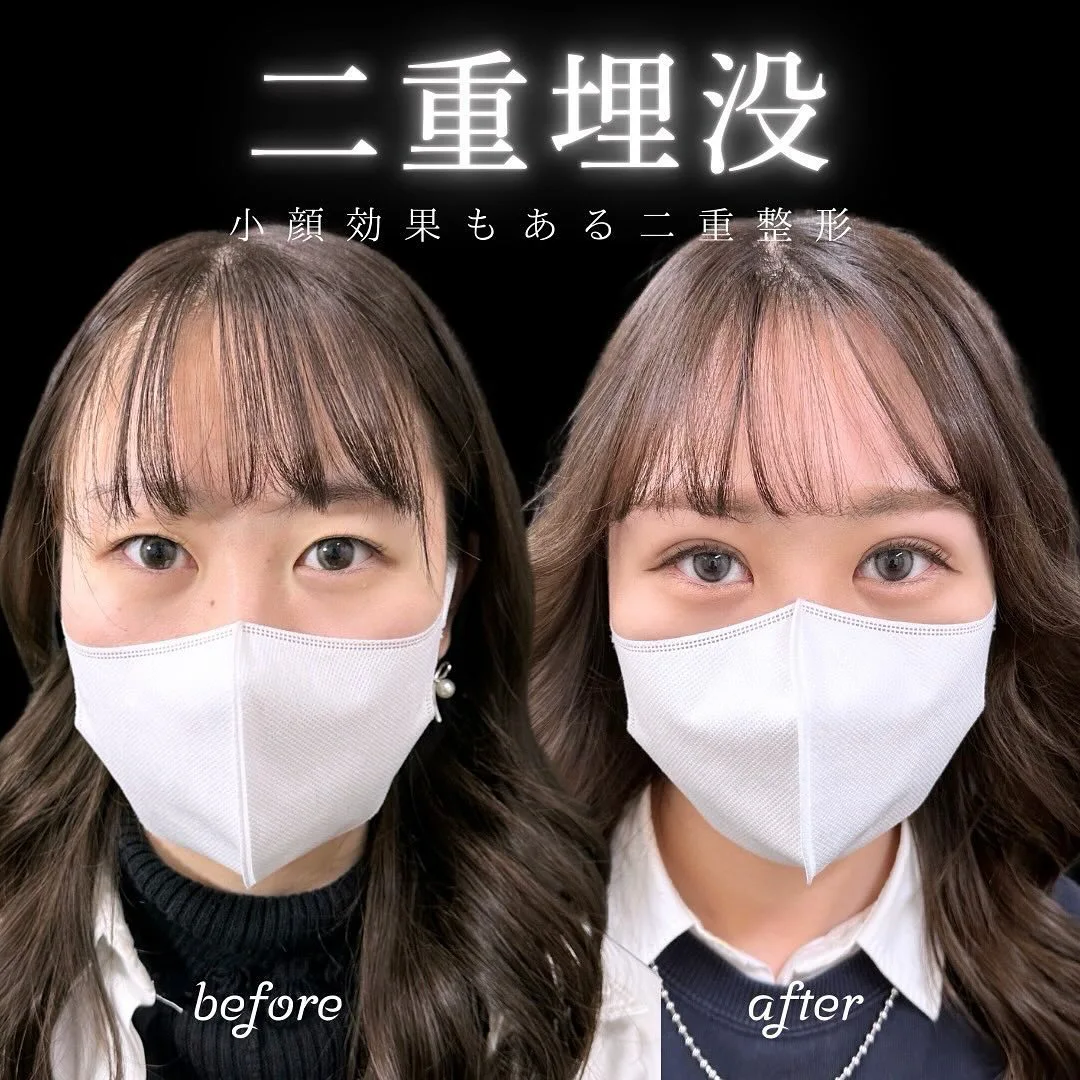 二重埋没の症例写真（施術前・施術直後・正面）