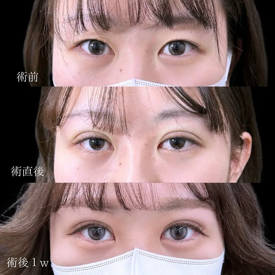 二重埋没の症例写真（施術前・施術直後・1週間後）
