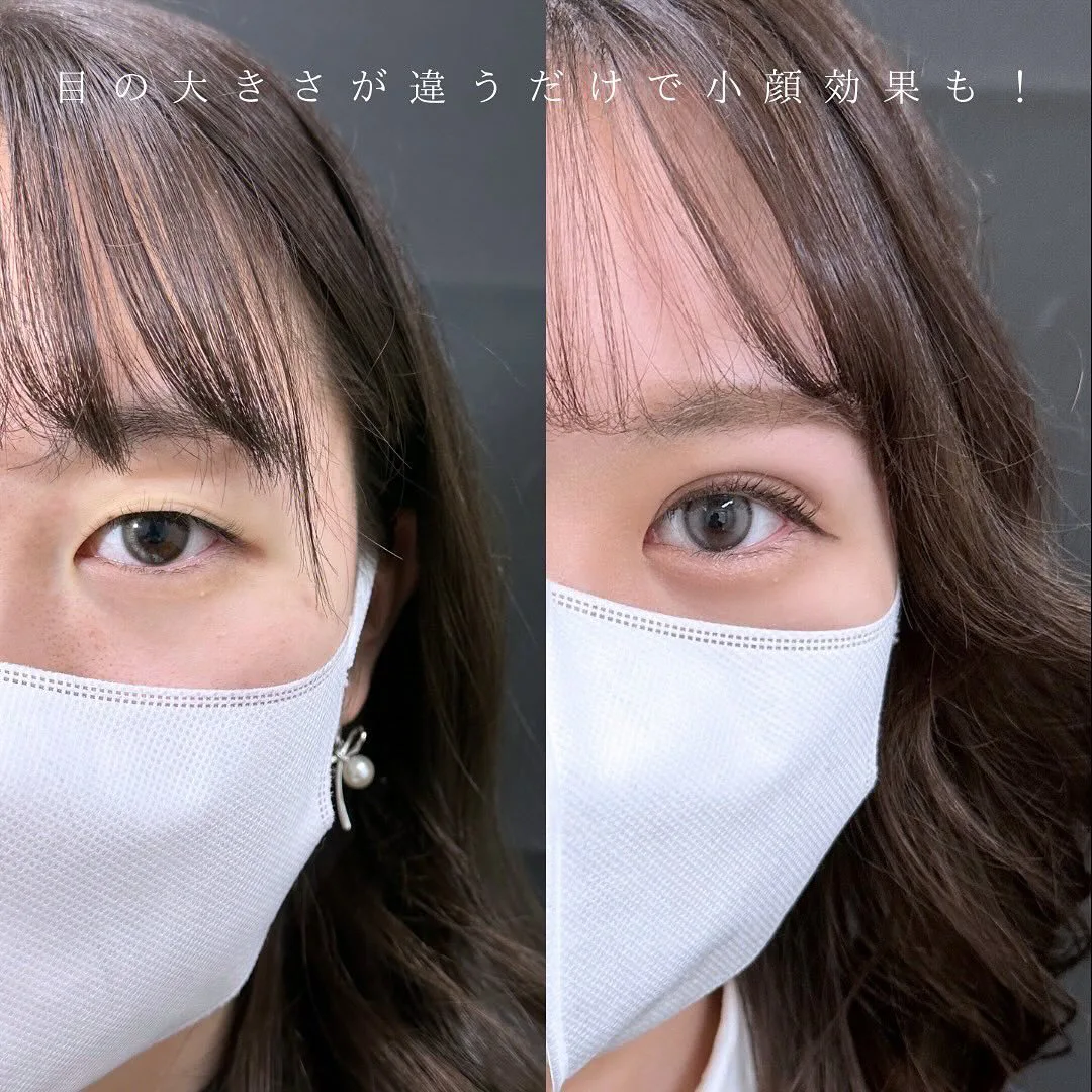 二重埋没の症例写真（施術前・施術1週間後）