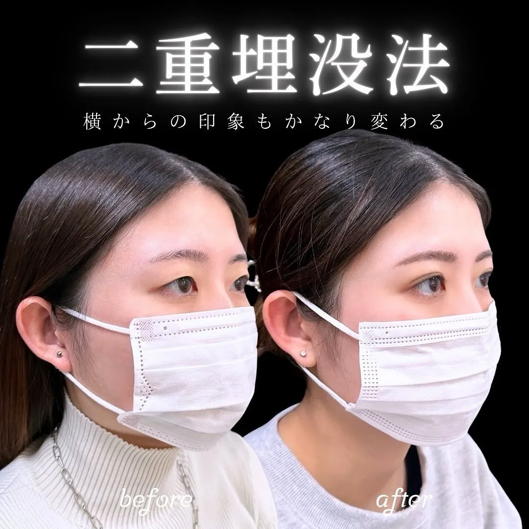 末広型二重埋没の症例写真（施術前・施術後・斜め）""