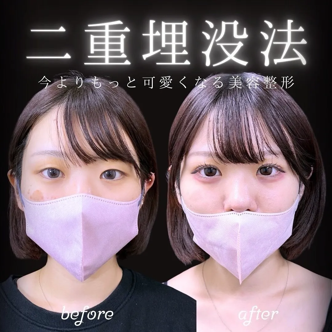 二重埋没の症例写真（施術前・3週間後）