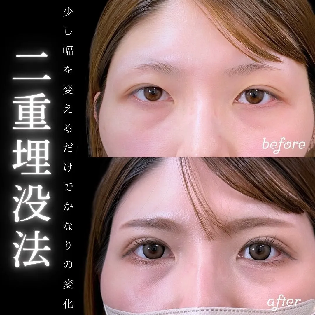 二重埋没の症例写真（施術前・施術後）