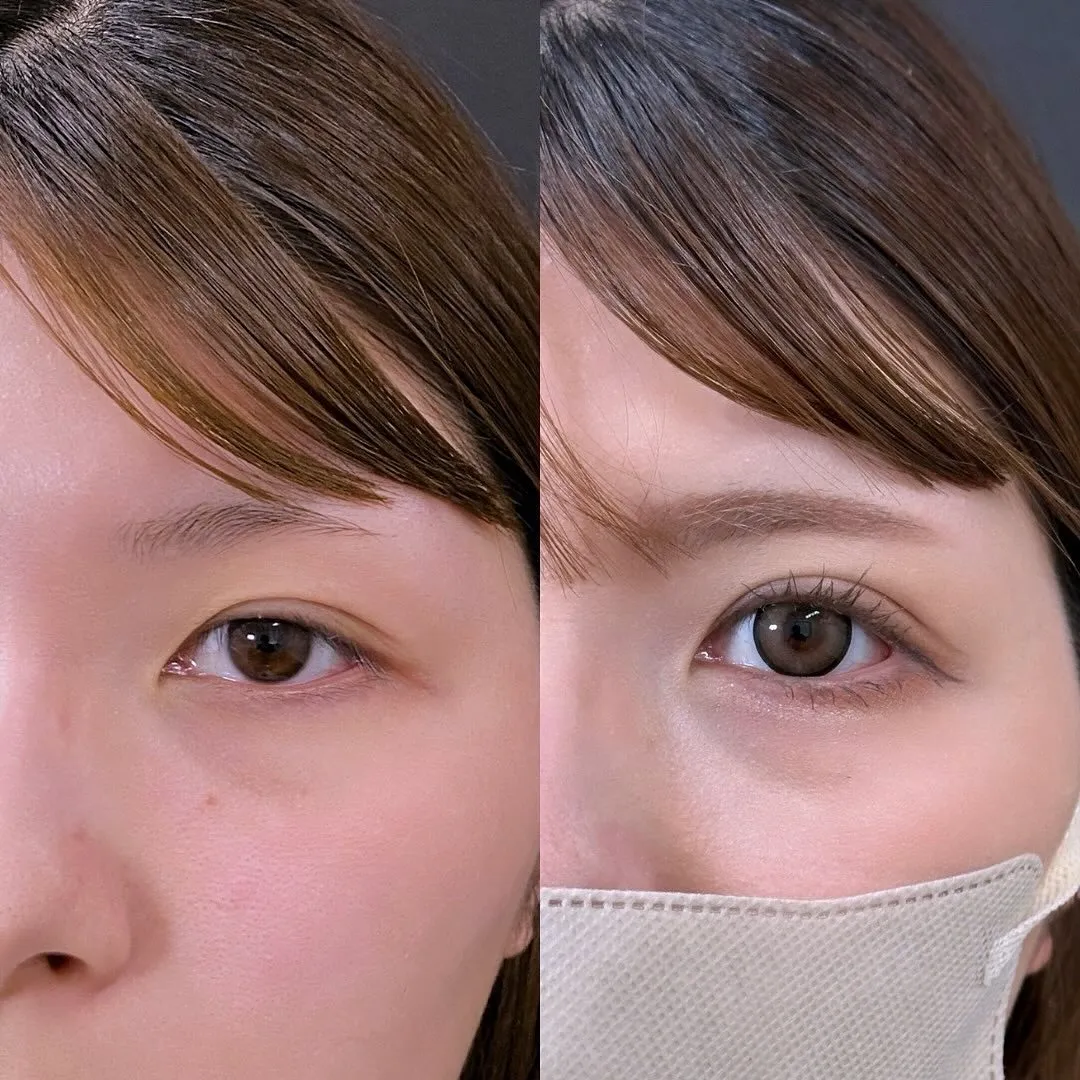 二重埋没の症例アップ写真（施術前・3週間後）