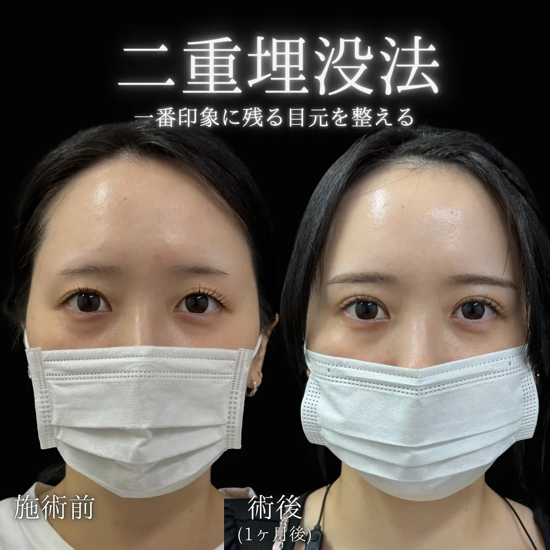 二重埋没の症例写真（施術前・1か月後）
