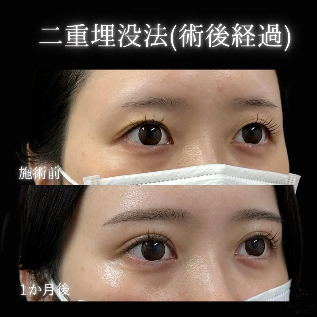 二重埋没の症例アップ写真（施術前・1か月後）