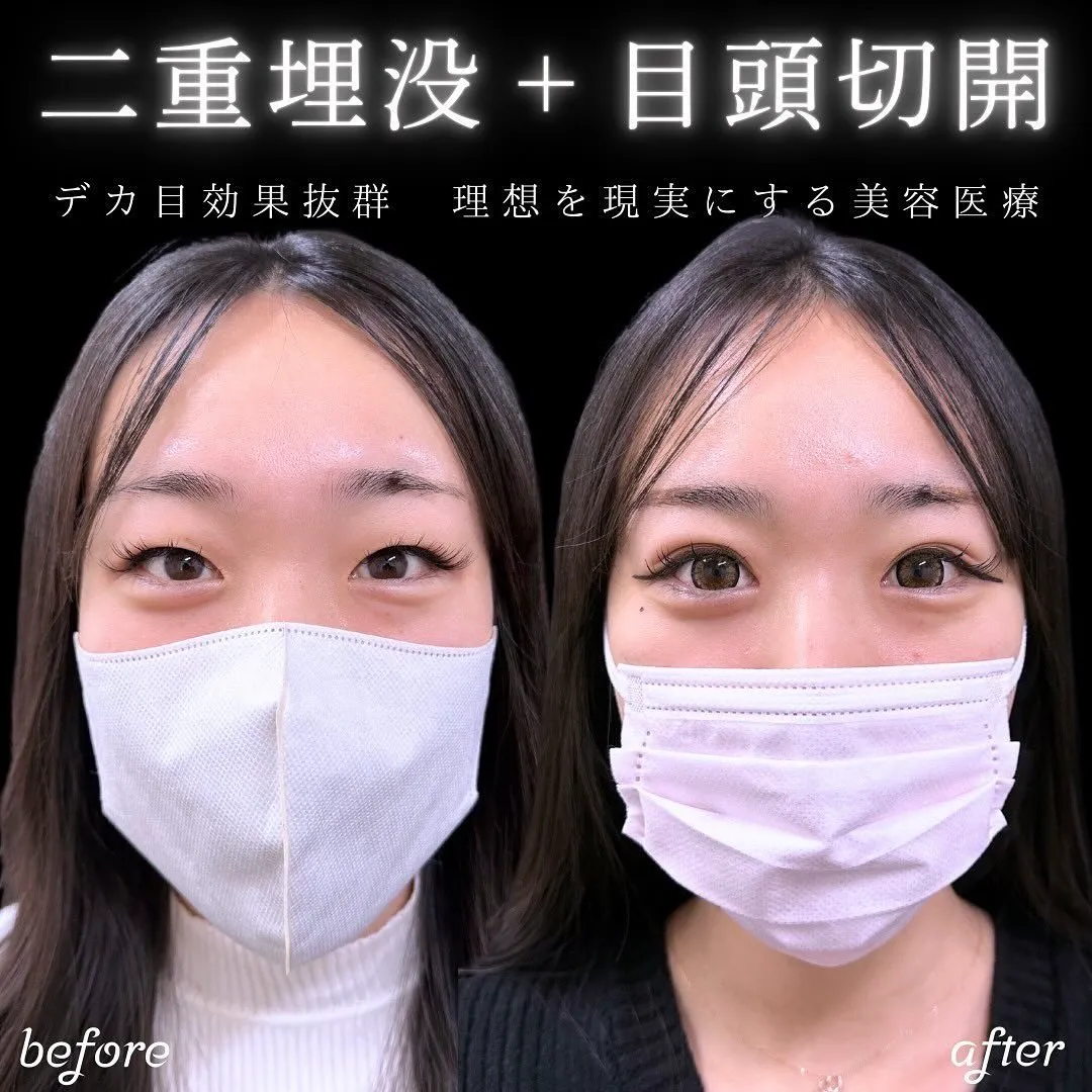 二重埋没と目頭切開の症例写真（施術前・施術後）