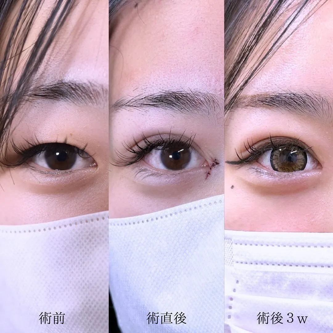 二重埋没の症例写真（施術前・施術直後・施術後3週間）