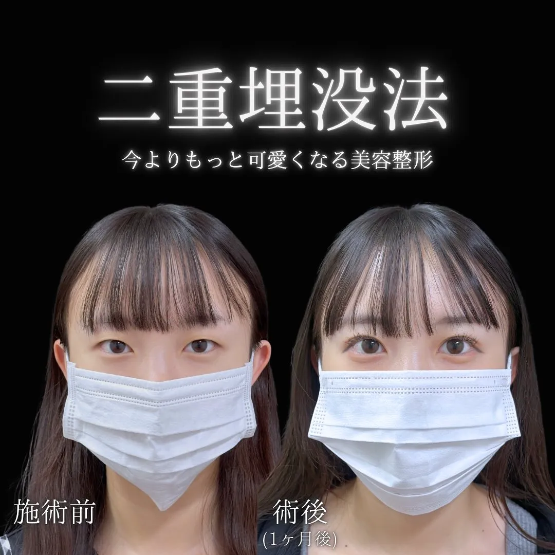 二重埋没の症例写真（施術前・1か月後）