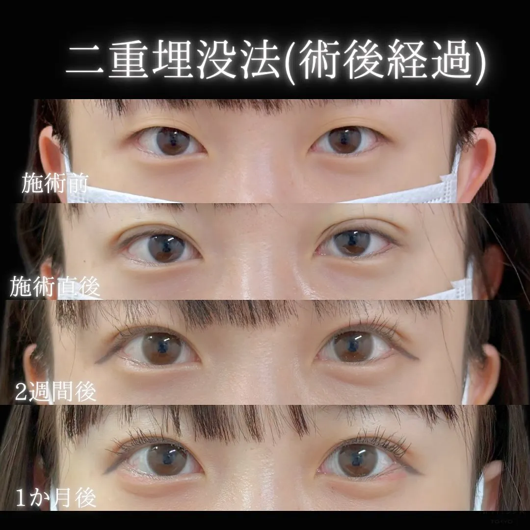 二重埋没の症例写真（施術前・施術直後・2週間後・1か月後）