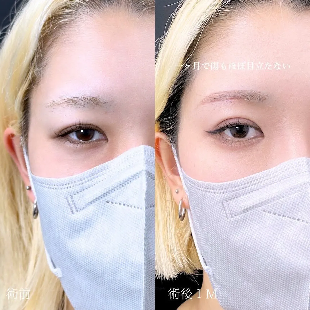 眉下切開の症例写真（施術前・施術後1週間）