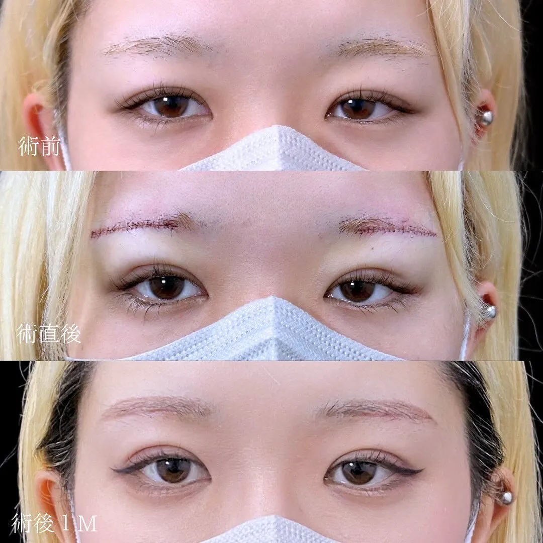 眉下切開の症例写真（施術前・施術直後・施術後1週間）