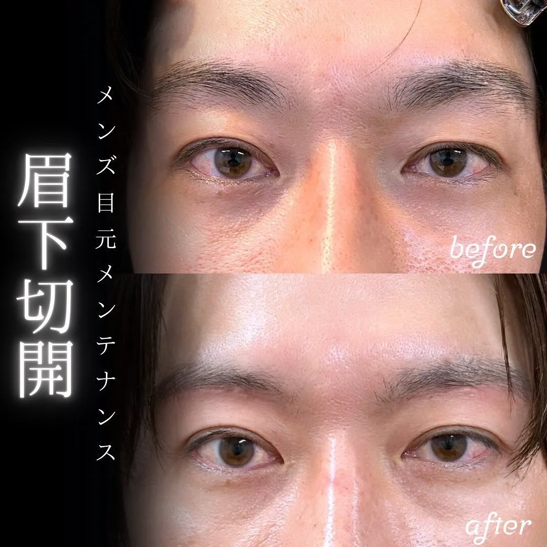 眉下切開の症例写真（施術前・施術後）