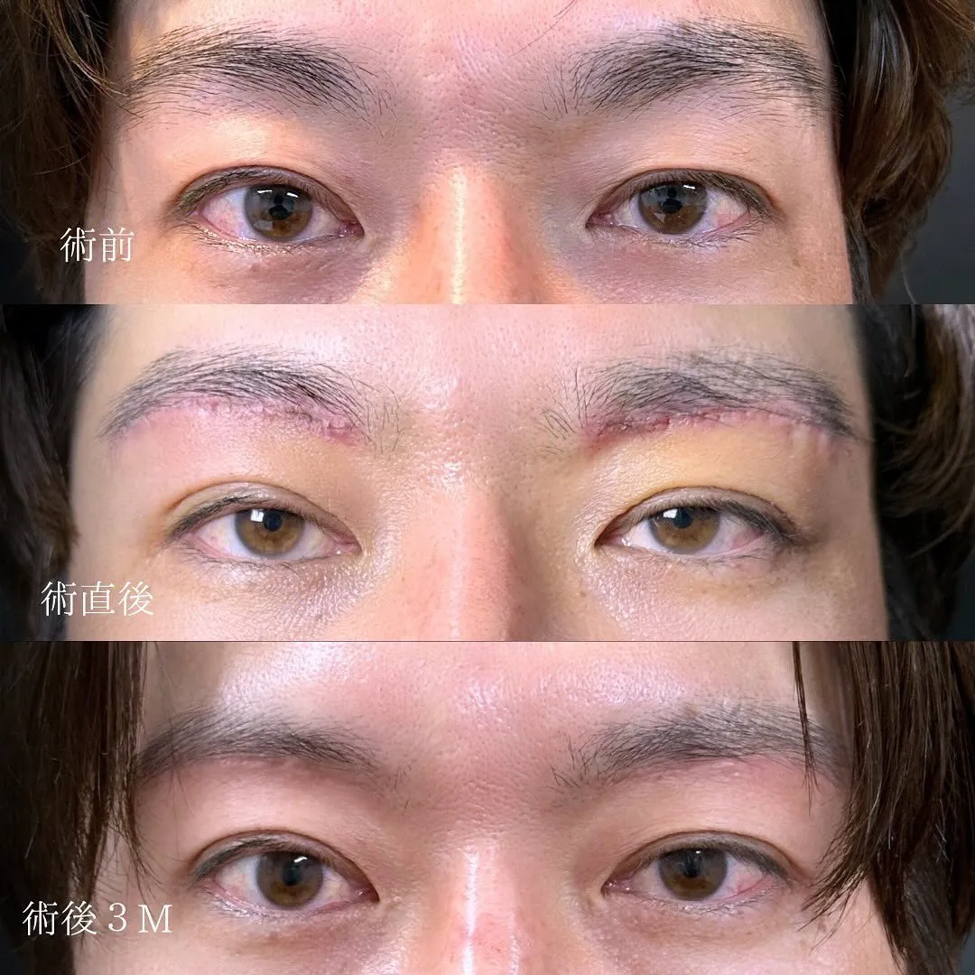 眉下切開の症例写真（施術前・施術直後・施術後3か月）