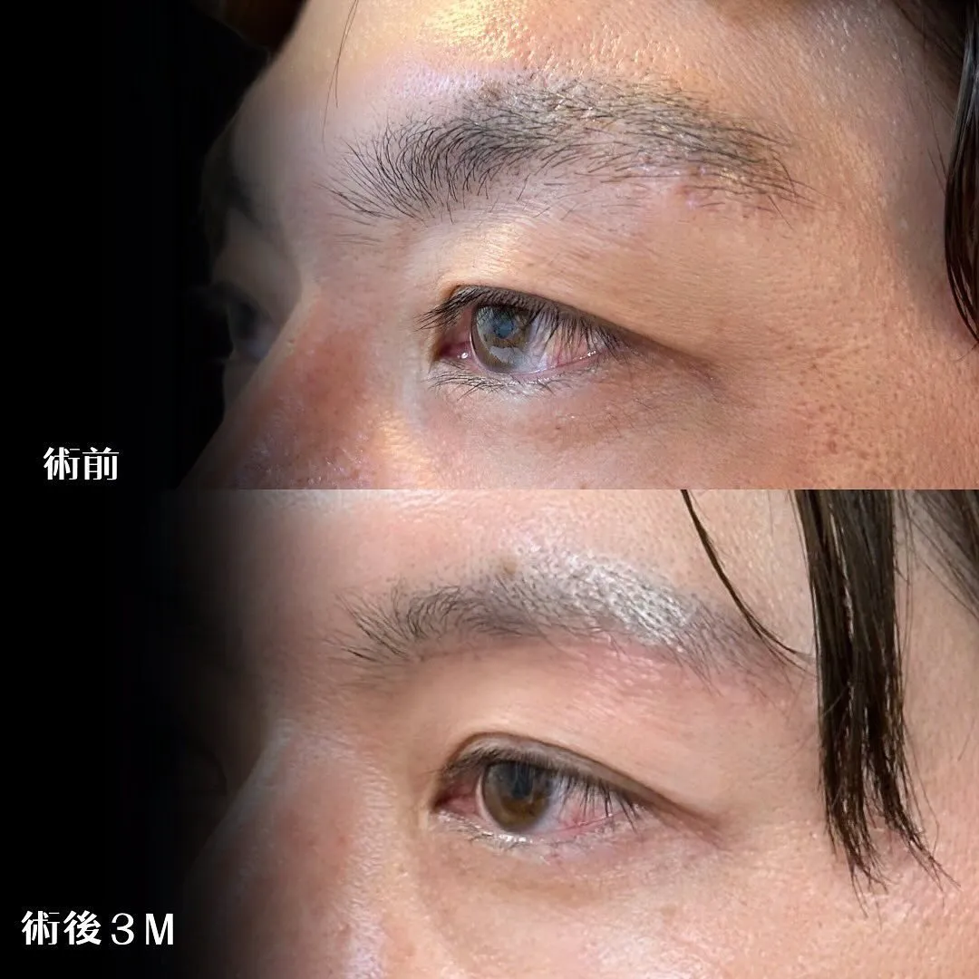 眉下切開の症例アップ写真（施術前・施術後3か月）