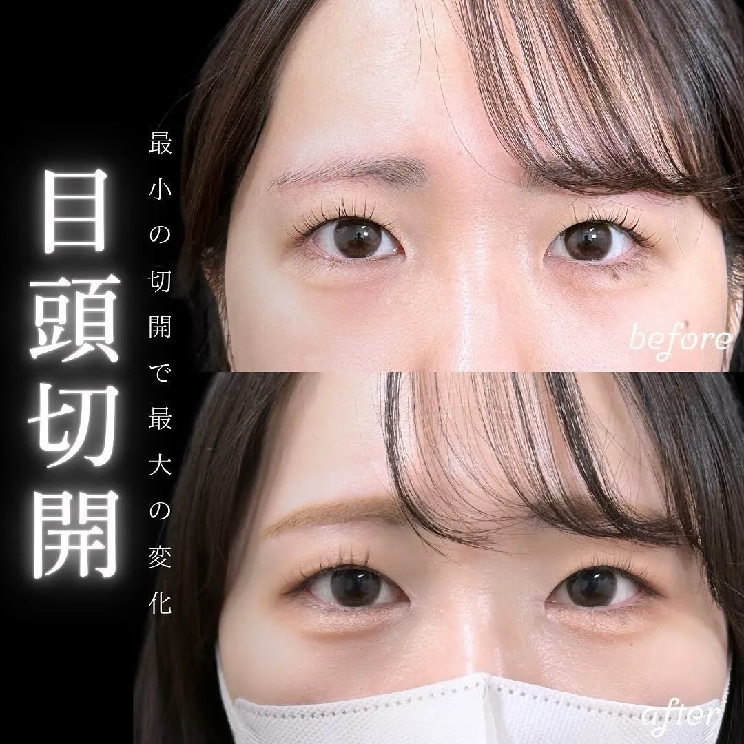 目頭切開の症例写真（施術前・施術後）
