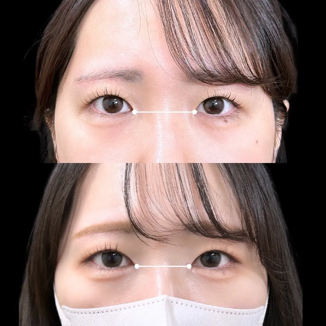 目頭切開の症例アップ写真（施術前・施術後）