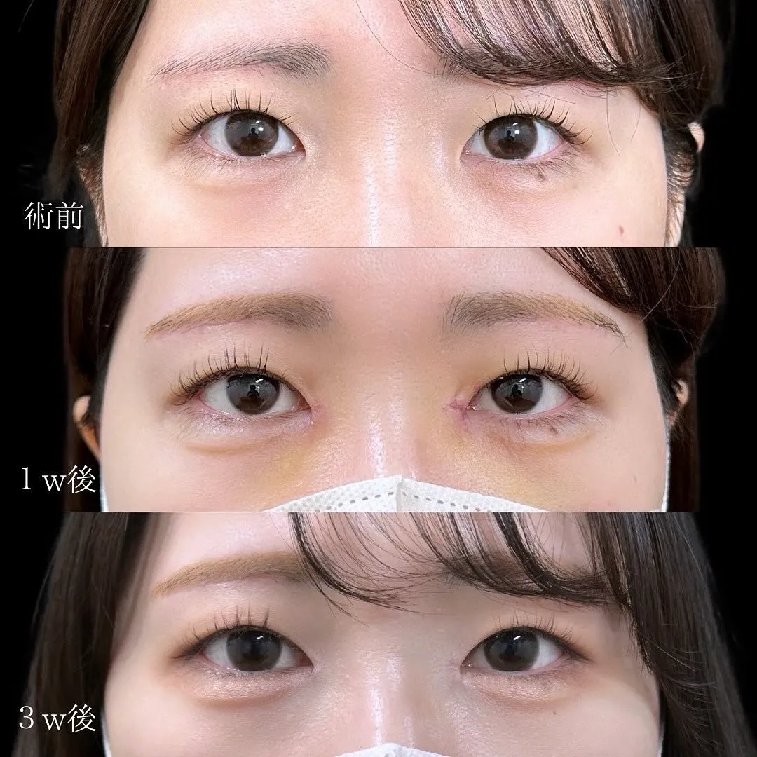 目頭切開の症例写真（施術前・施術後1週間・施術後3週間）