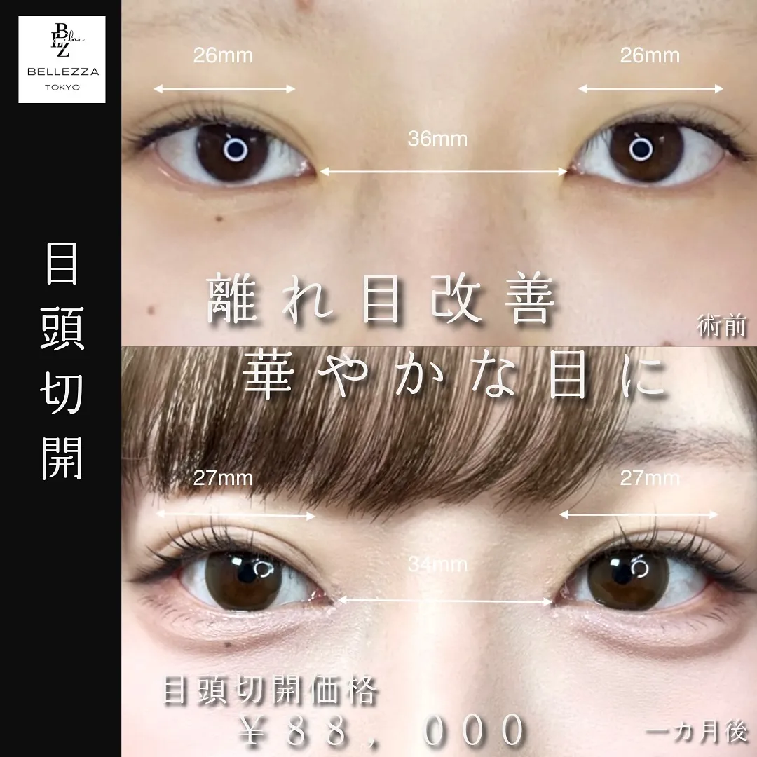 目頭切開の症例写真（施術前・施術後1か月）