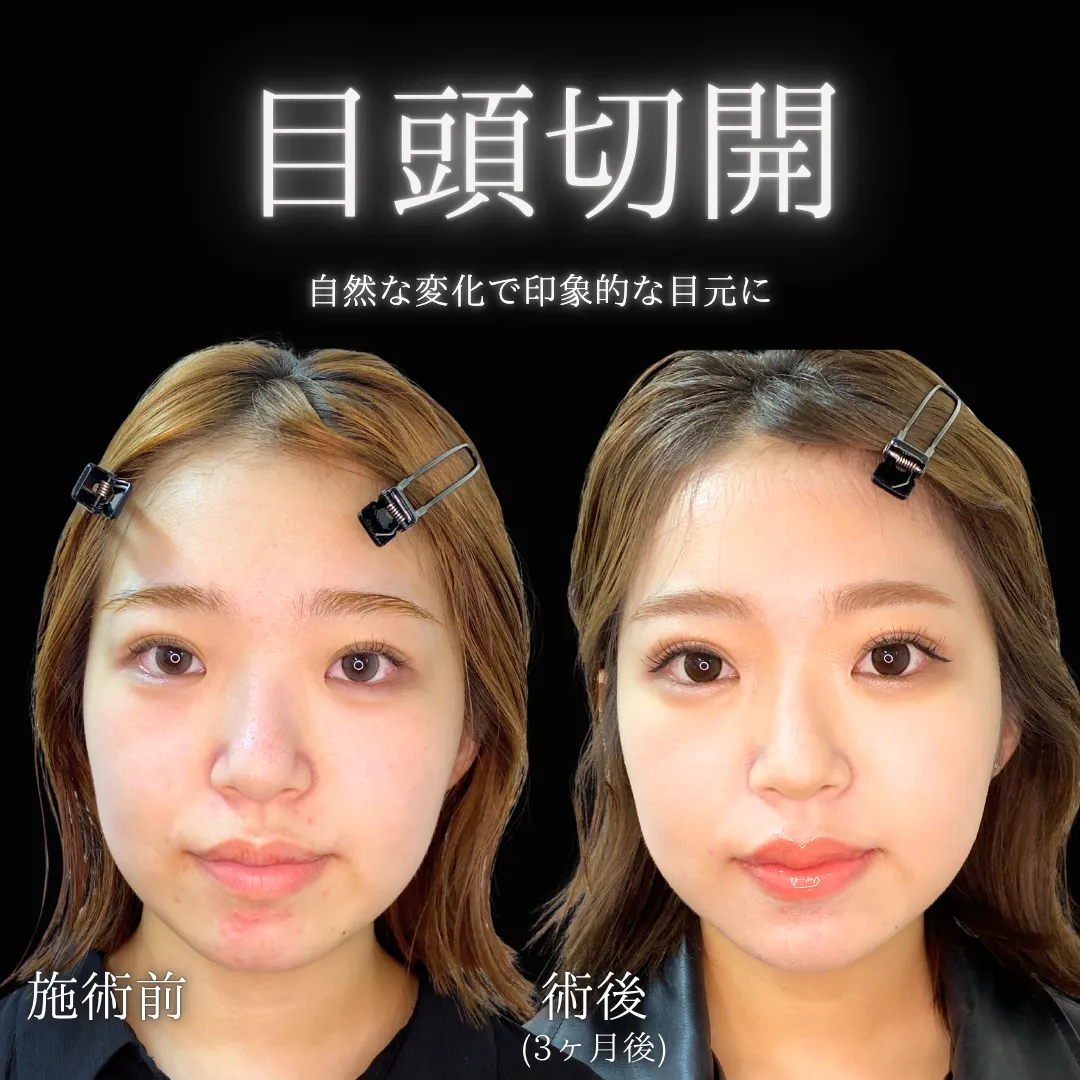 目頭切開の症例写真（施術前・施術後1か月）