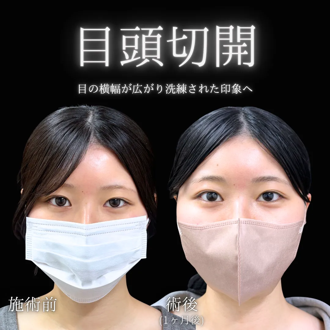 目頭切開の症例写真（施術前・施術後1か月）