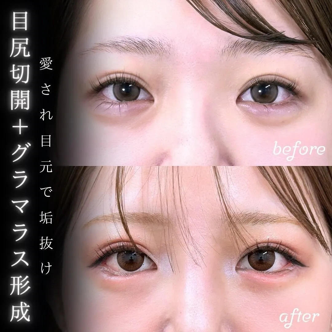 目尻切開の症例写真（施術前・施術後）