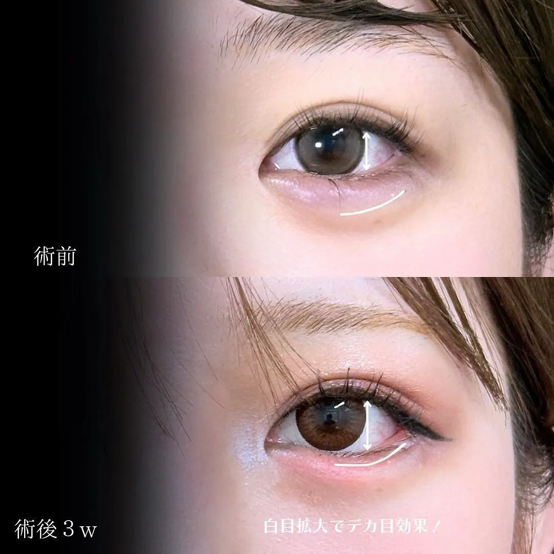 目尻切開の症例アップ写真（施術前・施術後3週間）